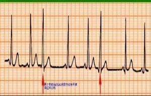 窦性心律什么什么意思（正常的心率）